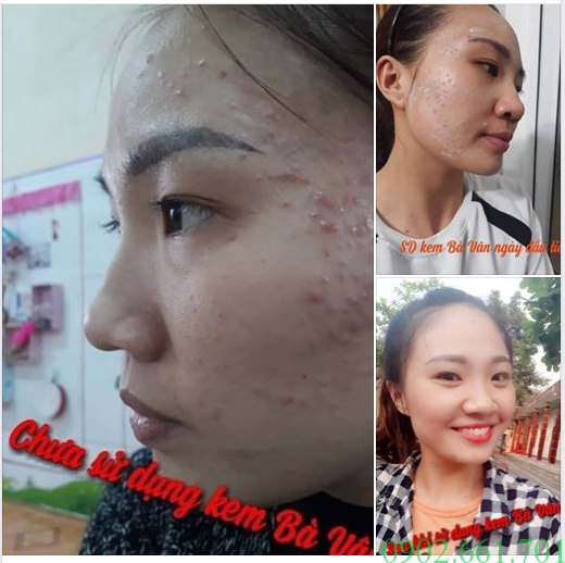 Công-dụng-kem-trị-mụn-đông-y-bà-vân