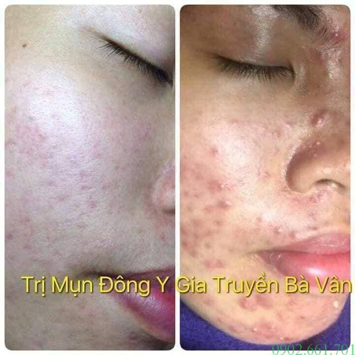 Tác-Dụng-Kem-Trị-Mụn-Đông-Y-Gia-Truyền-Bà-Vân